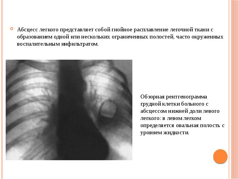Лучевая картина абсцесса легких