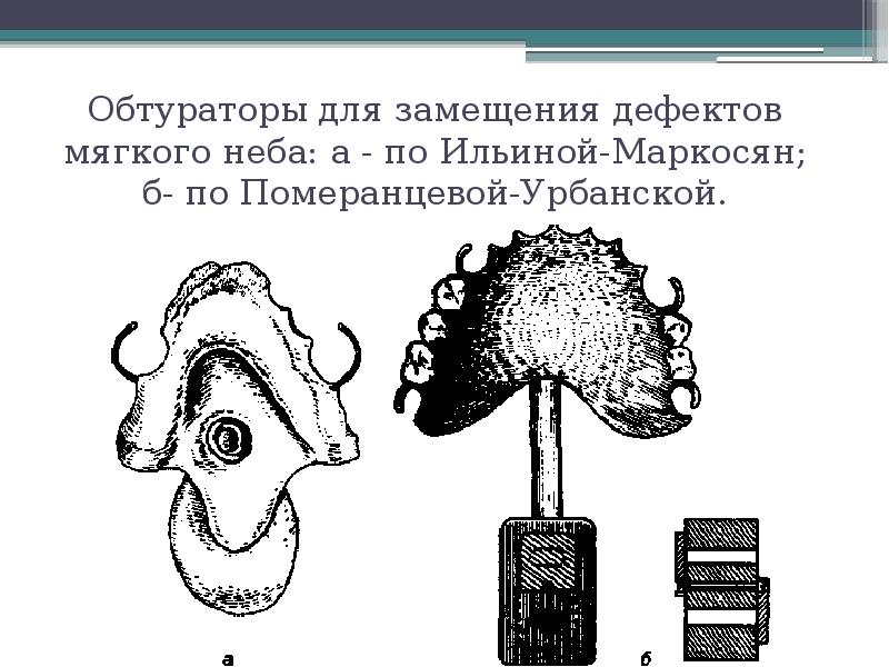 Обтураторы для замещения дефектов мягкого неба: а - по Ильиной-Маркосян; б-