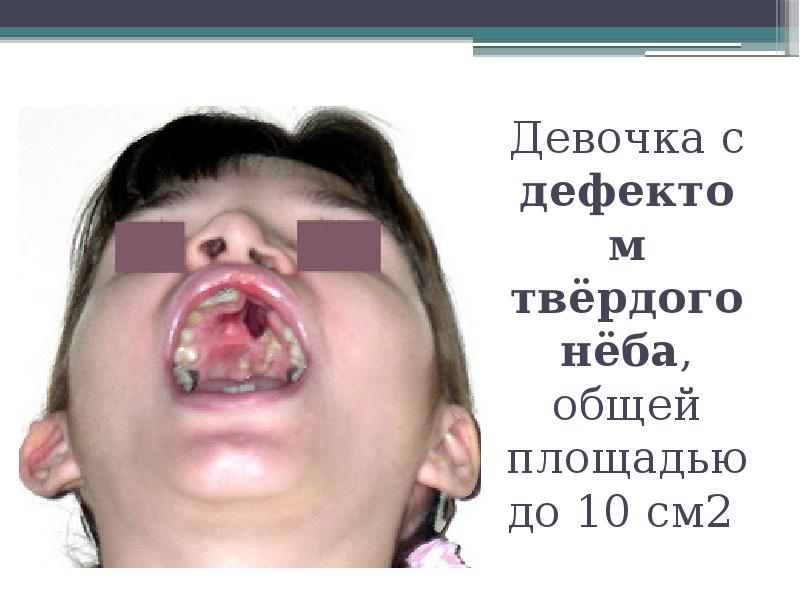 Девочка с дефектом твёрдого нёба, общей площадью до 10 см2