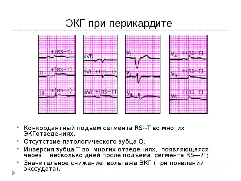 Конкордантный подъем сегмента. Инвертированный зубец т на ЭКГ. Электрокардиограмма при перикардите. ЭКГ при инфаркте с инверсией зубца t. Патологический зубец QS на ЭКГ.