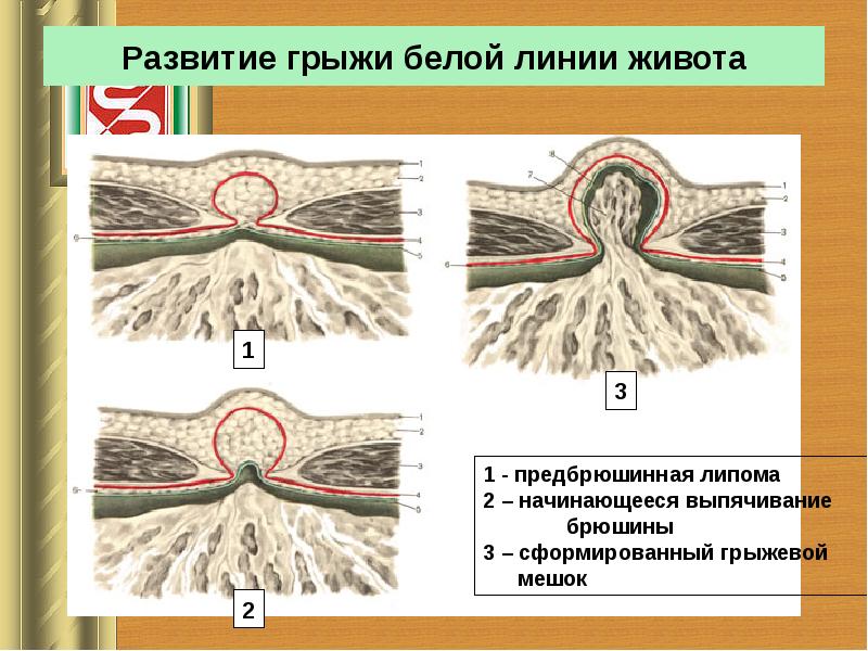 Наружные и внутренние грыжи живота презентация