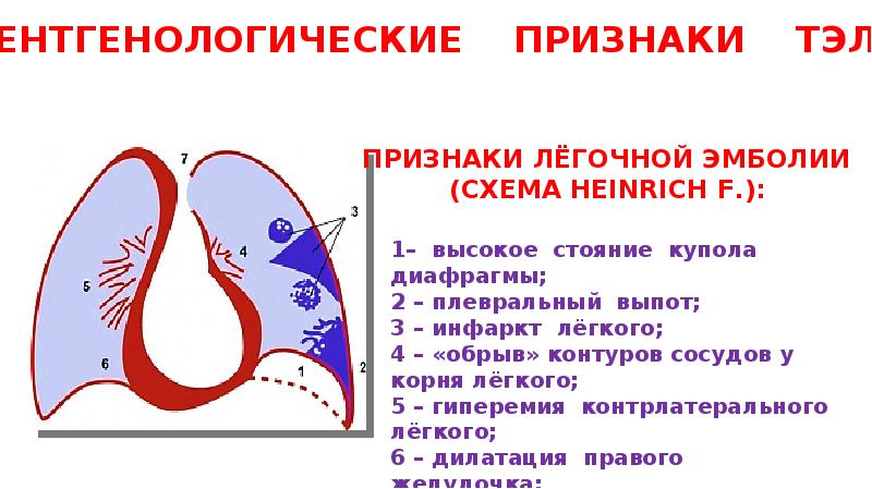 Тромбоэмболия легочной артерии презентация