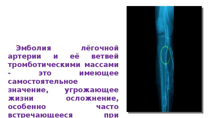 Тромбоэмболия легочной артерии презентация