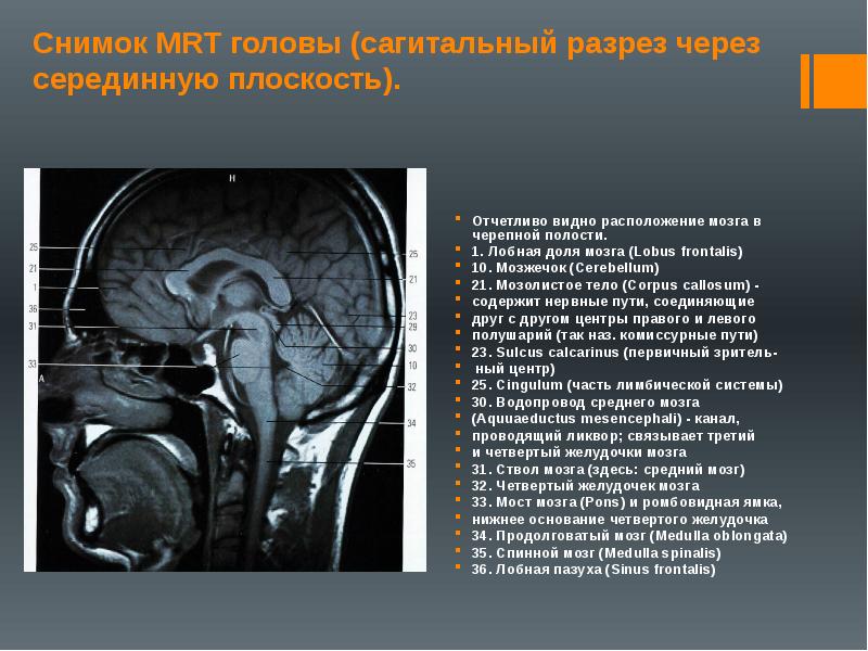 Отчетливо это. Мозолистое тело анатомия мрт. Мозолистое тело анатомия кт. Гипоплазия ствола мозолистого тела. Гипоплазия мозолистого тела кт.