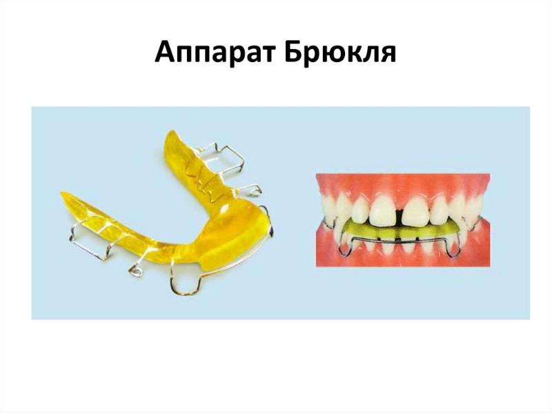 Презентация ортодонтические дуги