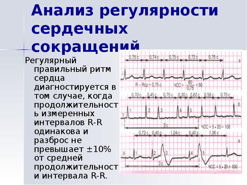 Как определить частоту сердечных сокращений. Регулярность сердечных сокращений на ЭКГ. Правильный ритм на ЭКГ.