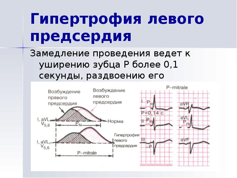 Гипертрофия левого предсердия на экг