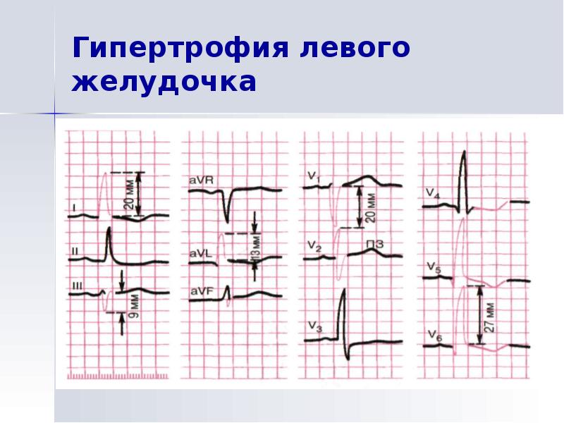 Индексы гипертрофии левого желудочка. Индексы гипертрофии левого желудочка