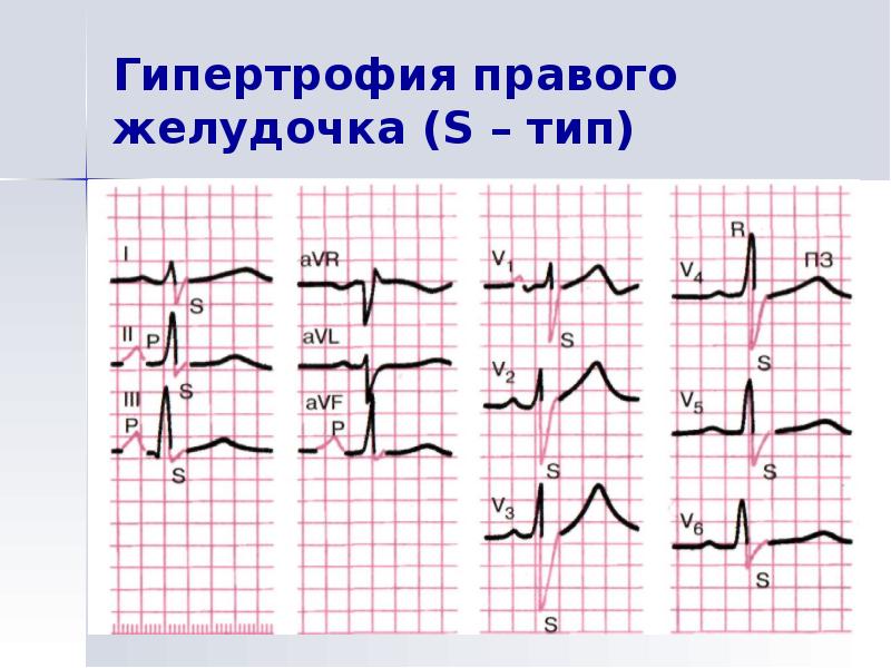 Глж на экг. ОИМ правого желудочка на ЭКГ. Инфаркт правого желудочка на ЭКГ. Гипертрофия правого желудочка на ЭКГ. ЭКГ гипертрофия правого желудочка ЭКГ.