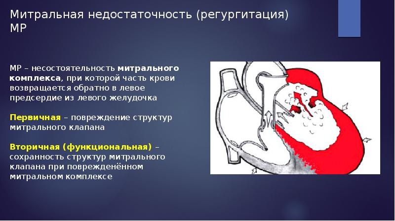 Презентация на тему недостаточность митрального клапана