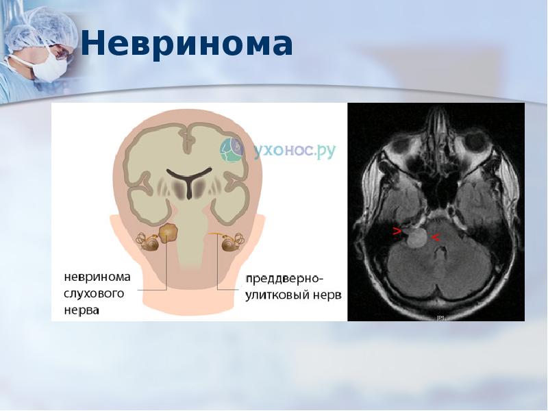 Невринома. Невринома слухового нерва кт. Шваннома слухового нерва кт. Невринома преддверно-улиткового нерва мрт.