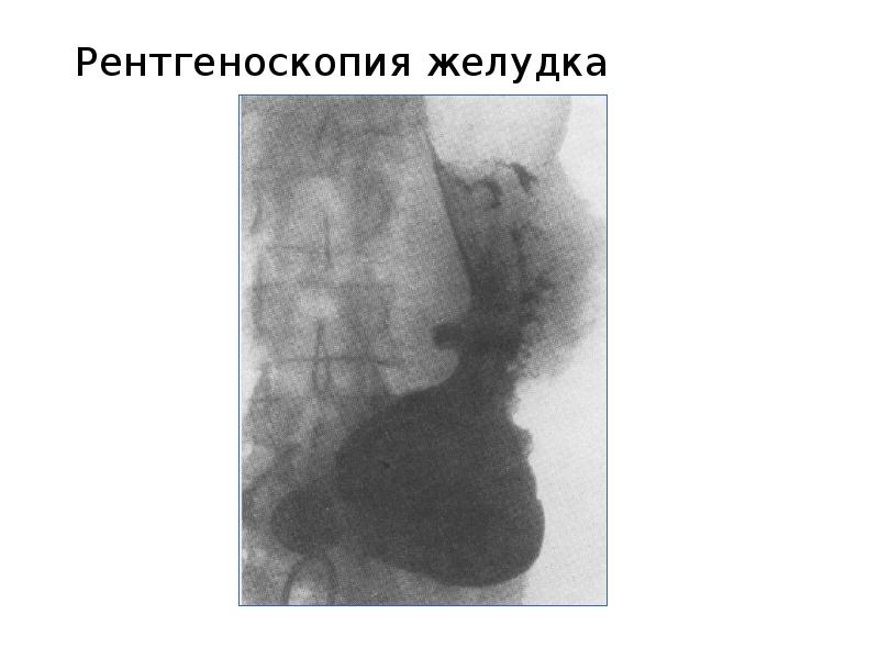 Рентгеноскопия пищевода и желудка в положении тренделенбурга что это такое фото