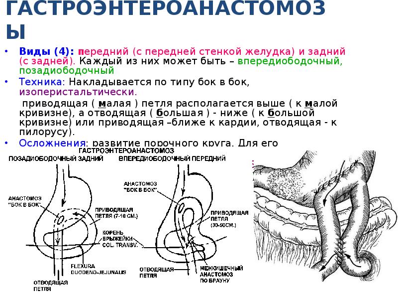 Анастомоз по брауну схема