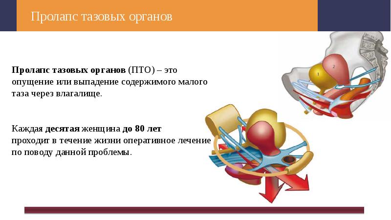 Пролапс это простыми словами. Пролапс опущение тазовых органов. Пролапс тазовых органов этиология. Пролапс тазовых органов презентация. Хирургическое лечение пролапса тазовых органов.