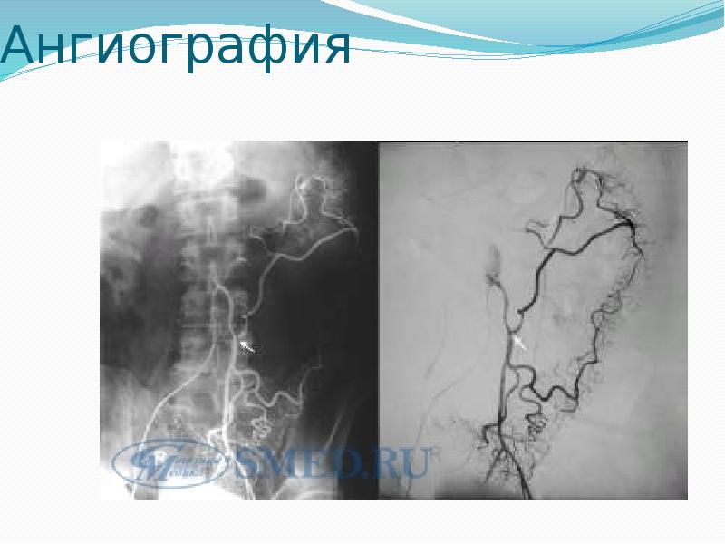 Синдром мезентериальной ишемии презентация