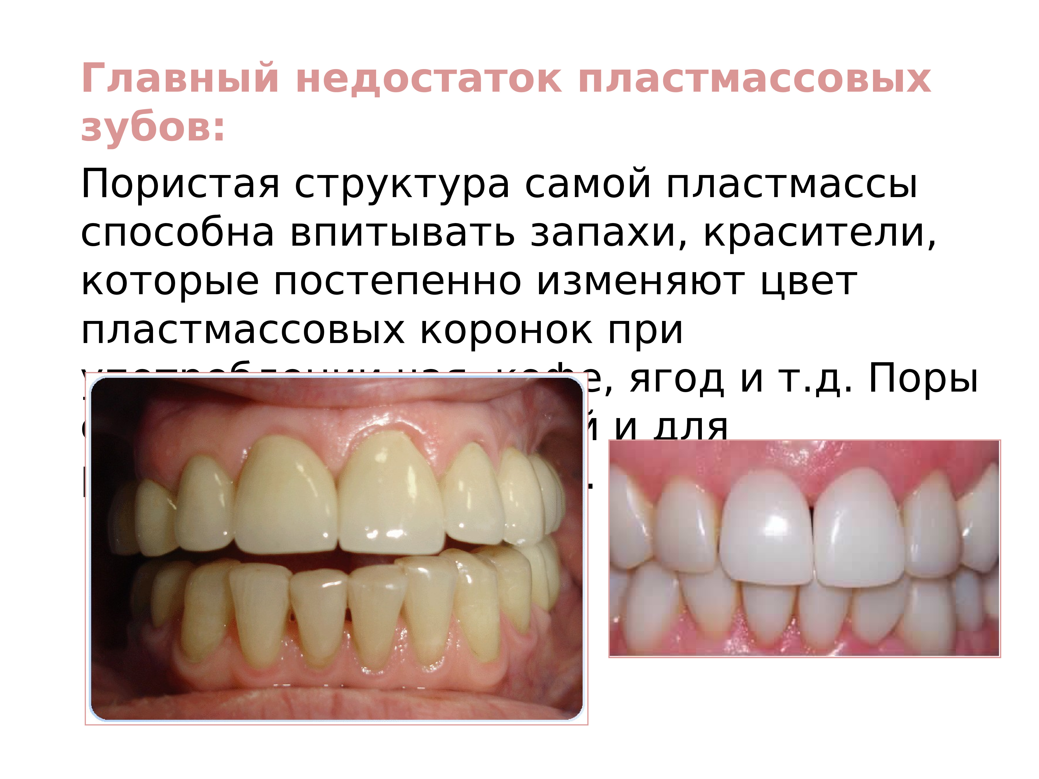 Полимерные материалы в ортопедической стоматологии