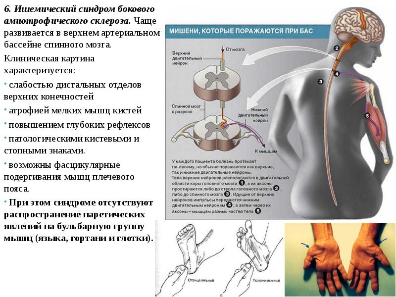 Презентация атрофия и склероз