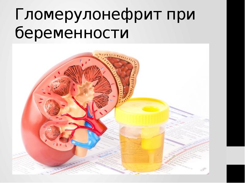 Гломерулонефрит при беременности