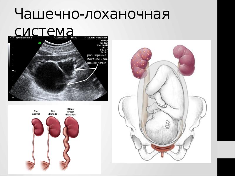 Чашечно-лоханочная система