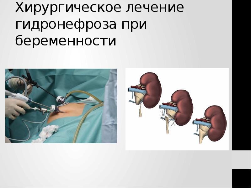 Хирургическое лечение гидронефроза при беременности