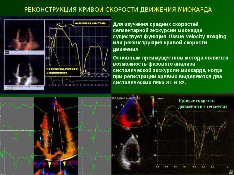 Эхокардиография с допплеровским анализом. Допплеровские методики. Тканевое допплеровское исследование. Лазерная допплеровская спектроскопия.