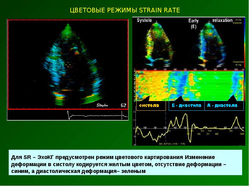 Эхокардиография с допплеровским анализом. Аневризма коронарного синуса ЭХОКГ. ЭХОКГ подготовка к исследованию. Двухмерная эхокардиография. Эхокардиография физиология.