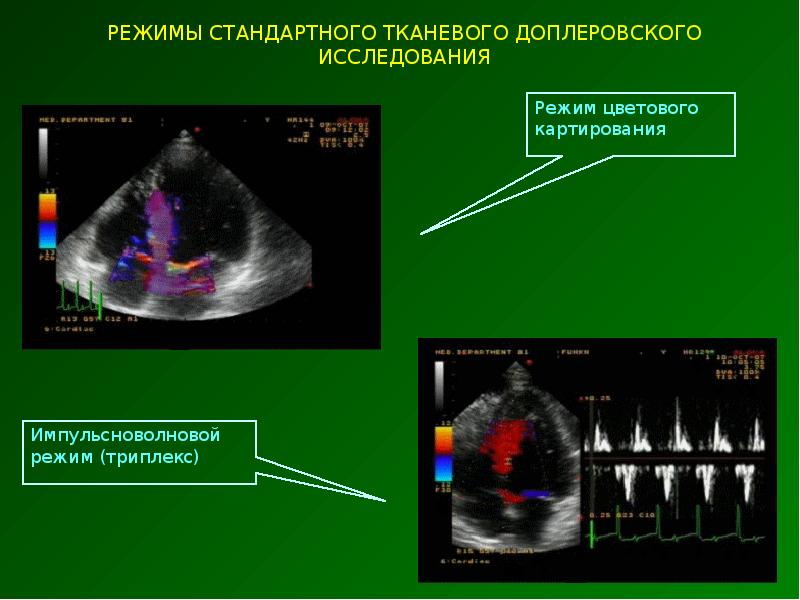 Режимы ик. Цветовое допплеровское картирование ЦДК. Тканевое допплеровское исследование. Доплеровское исследование в гинекологии. Режим цветового допплеровского картирования.