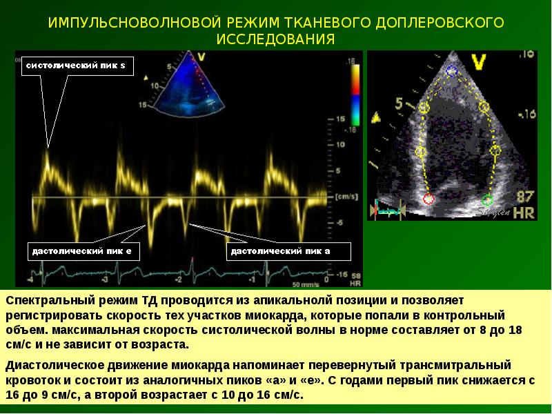 Спектральное допплеровское исследование. Ультразвуковая допплерография сосудов почек. Допплерометрия пупочной артерии. Допплеровское исследование что это. Дуплексное сканирование сосудов почек.