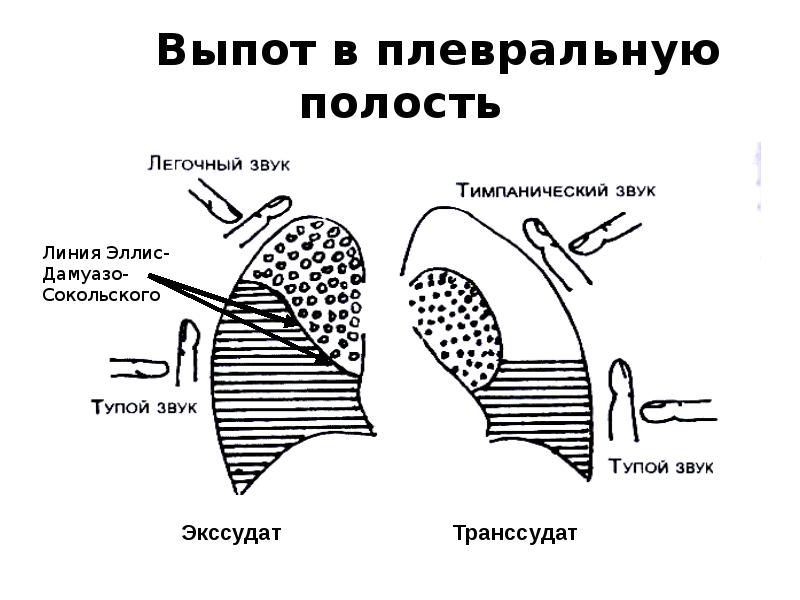 Плевральный выпот это. Плевральный выпот справа. Жидкость в плевральной полости до 7 ребра. Плевральный выпот перкуссия. Вскрытие остаточной плевральной полости.