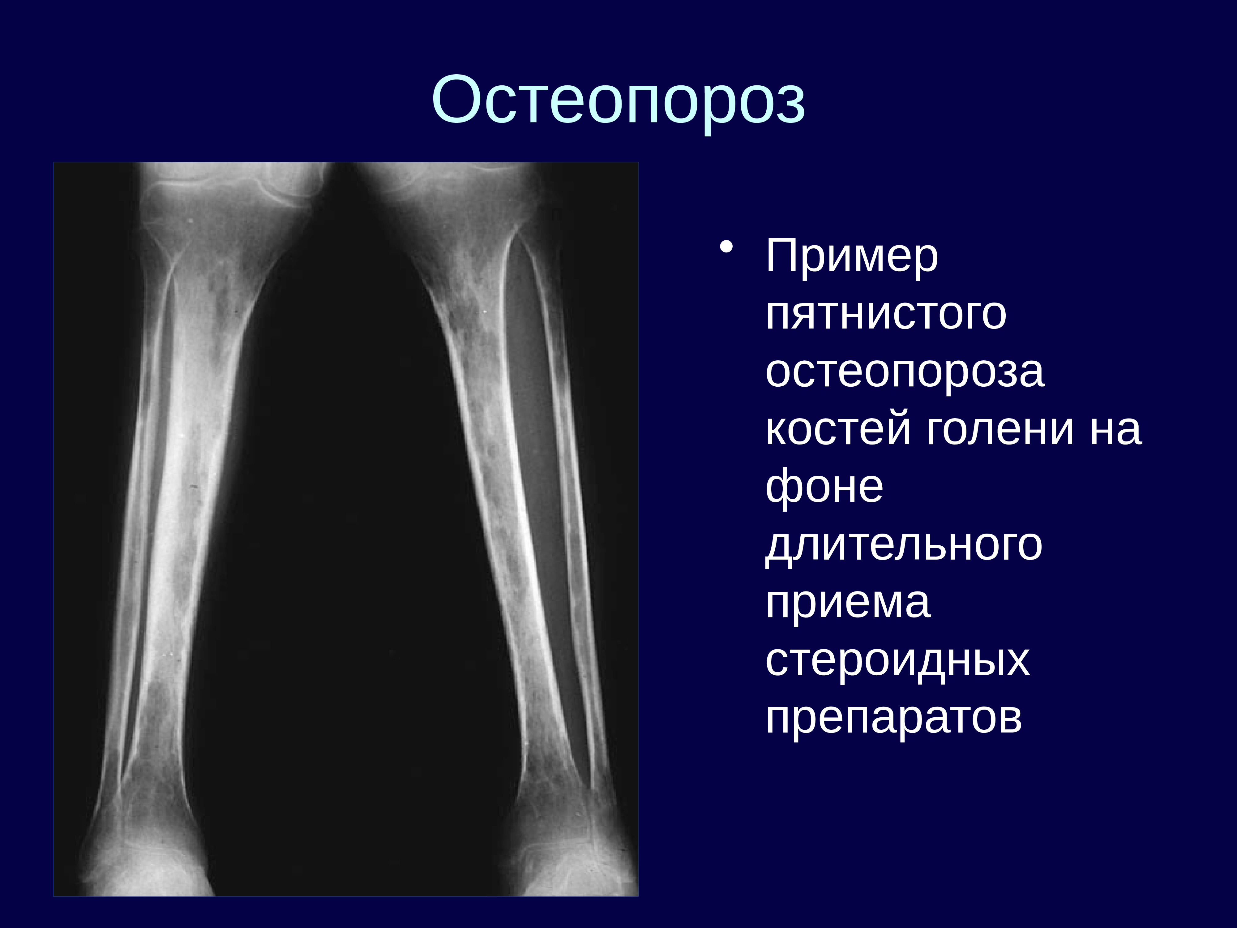 Очаговые изменения костей. Остеопороз лучевая диагностика костно-суставной системы. Остеопороз лучевых костей. Пятнистый остеопороз костей рентген. Посттравматический остеопороз бедренной кости.