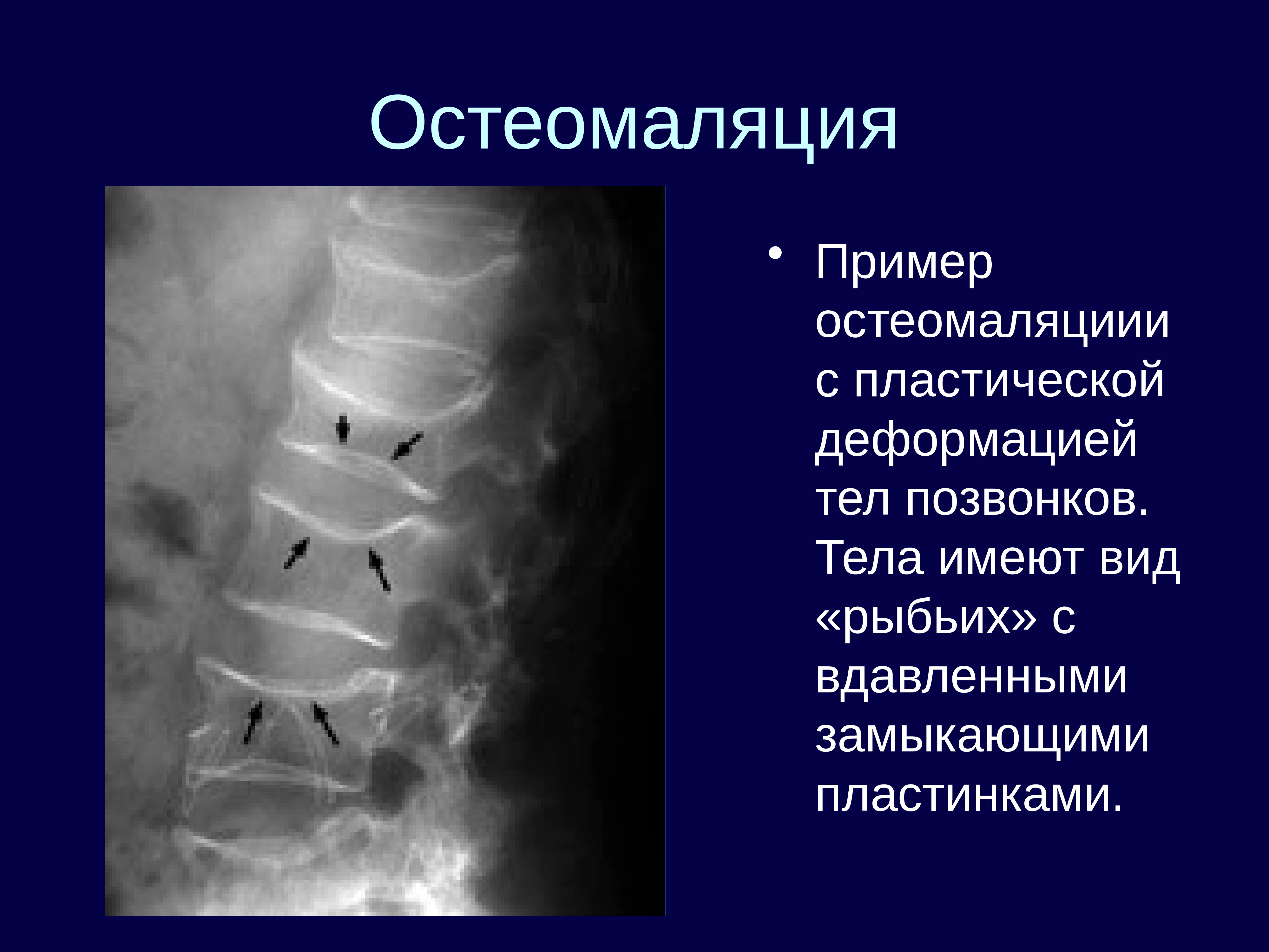 Форма тел позвонков. Остеомаляция тел позвонков. Остеомаляция рентген признаки. Рыбьи позвонки на рентгенограмме. Остеомаляция позвонков рентген.