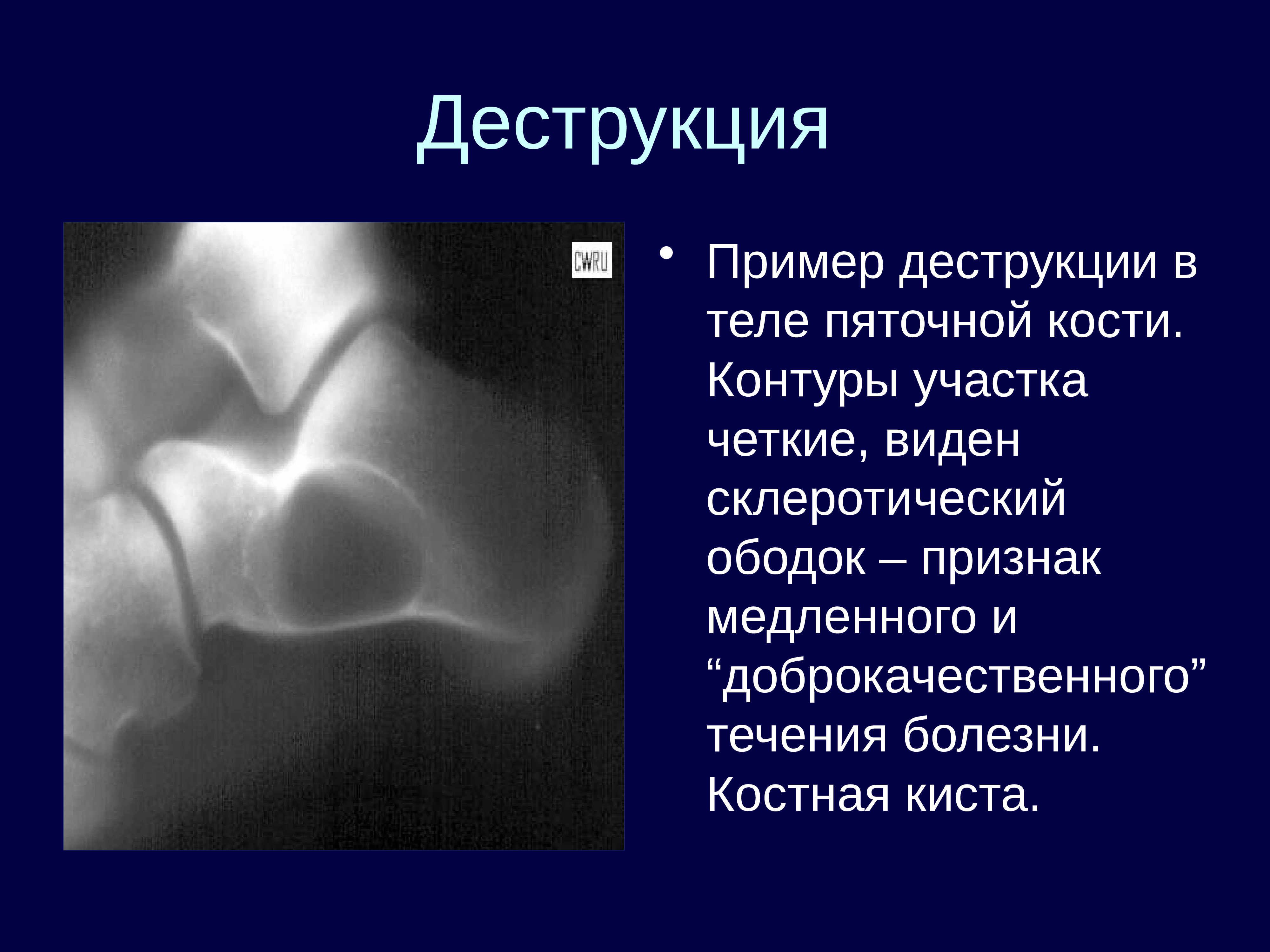 Деструкция это. Очаг деструкции в кости рентген. Очаг деструкции костной ткани рентген. Деструкция кости на рентгене. Киста пяточной кости рентген описание.