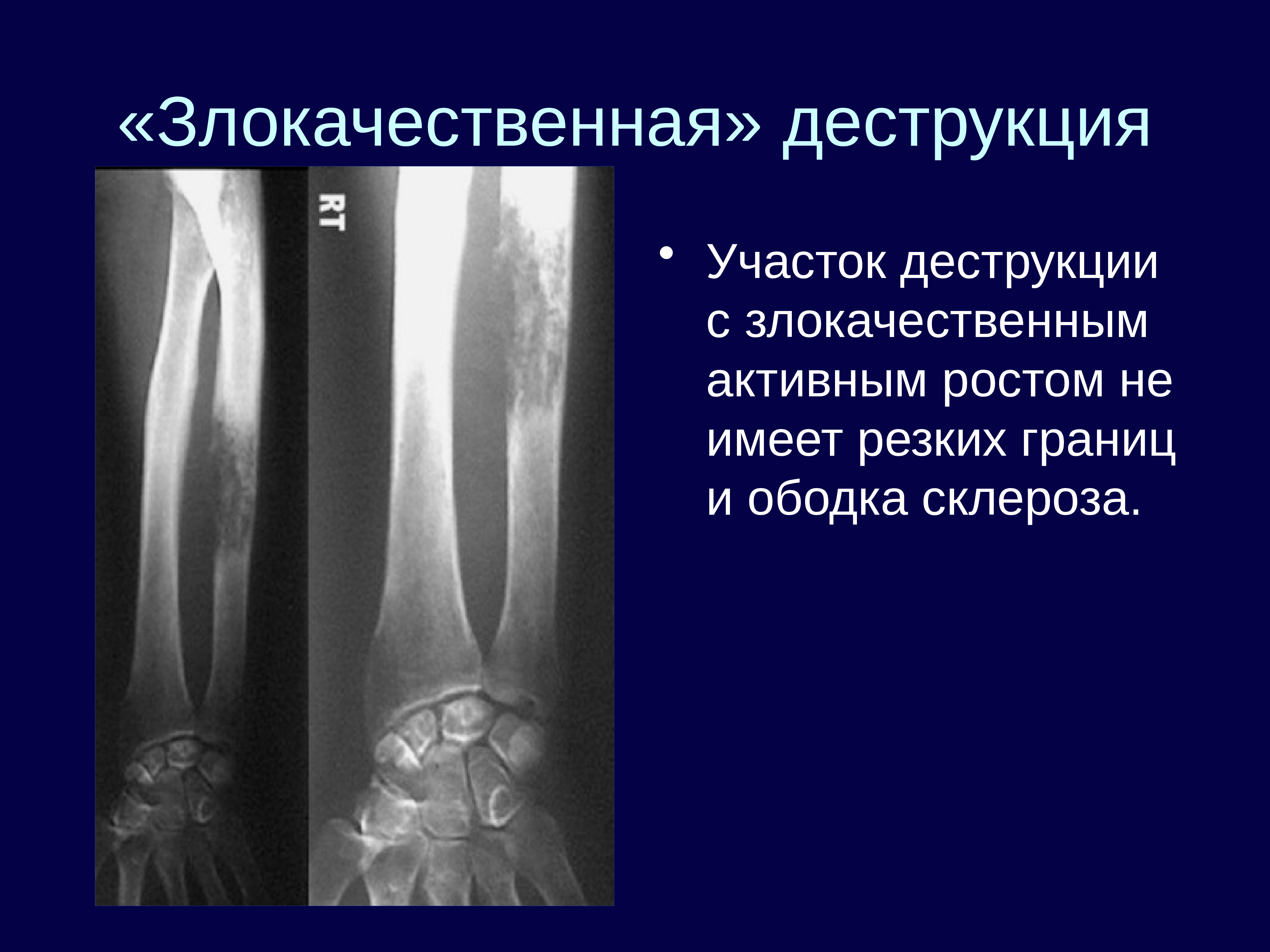 Рентгенодиагностика остеомиелита презентация