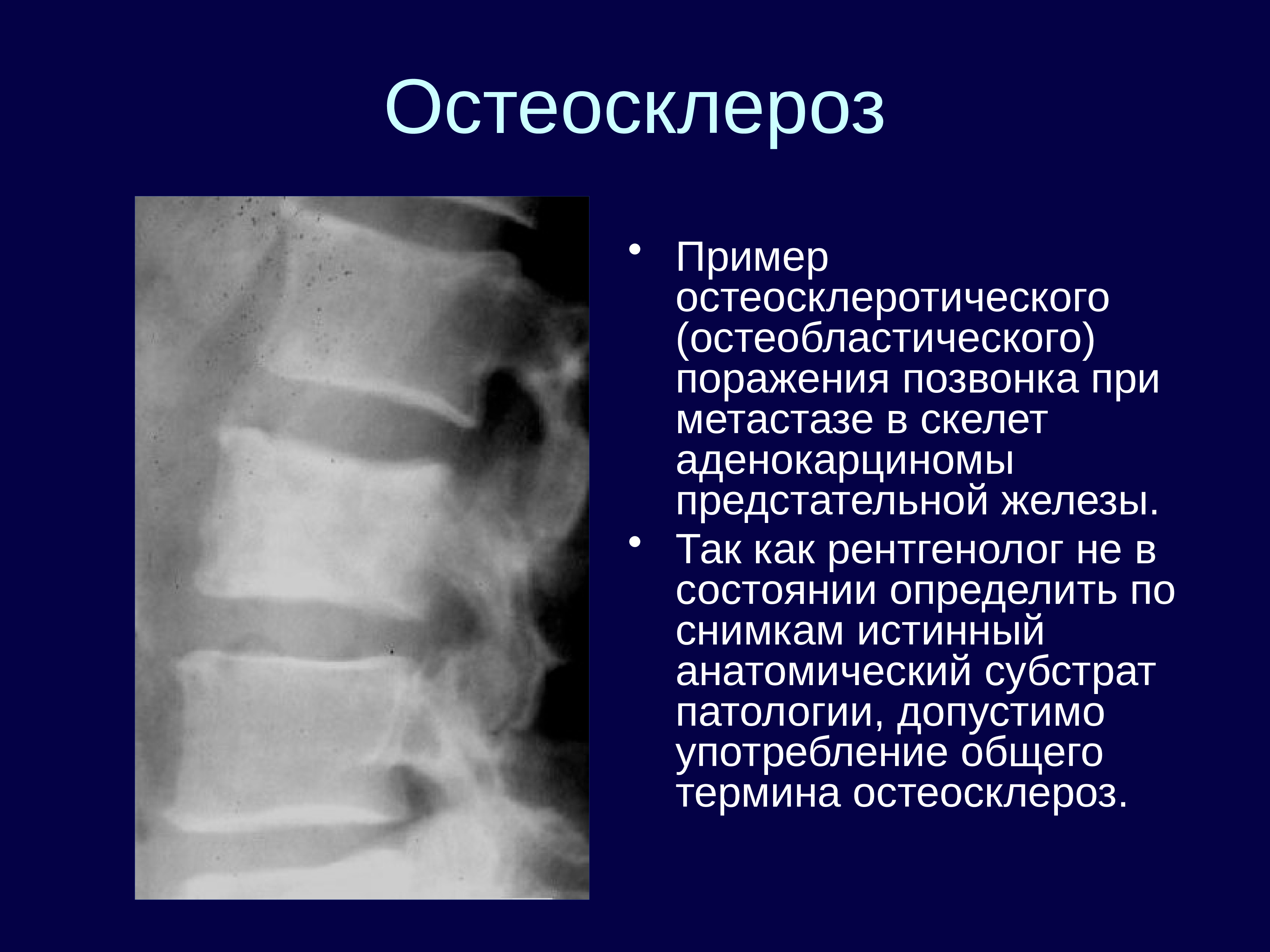 Очаг костей. Остеосклероз позвоночника th5. Пятнистый остеосклероз. Идиопатический остеосклероз. Субхондральный остеосклероз рентген.