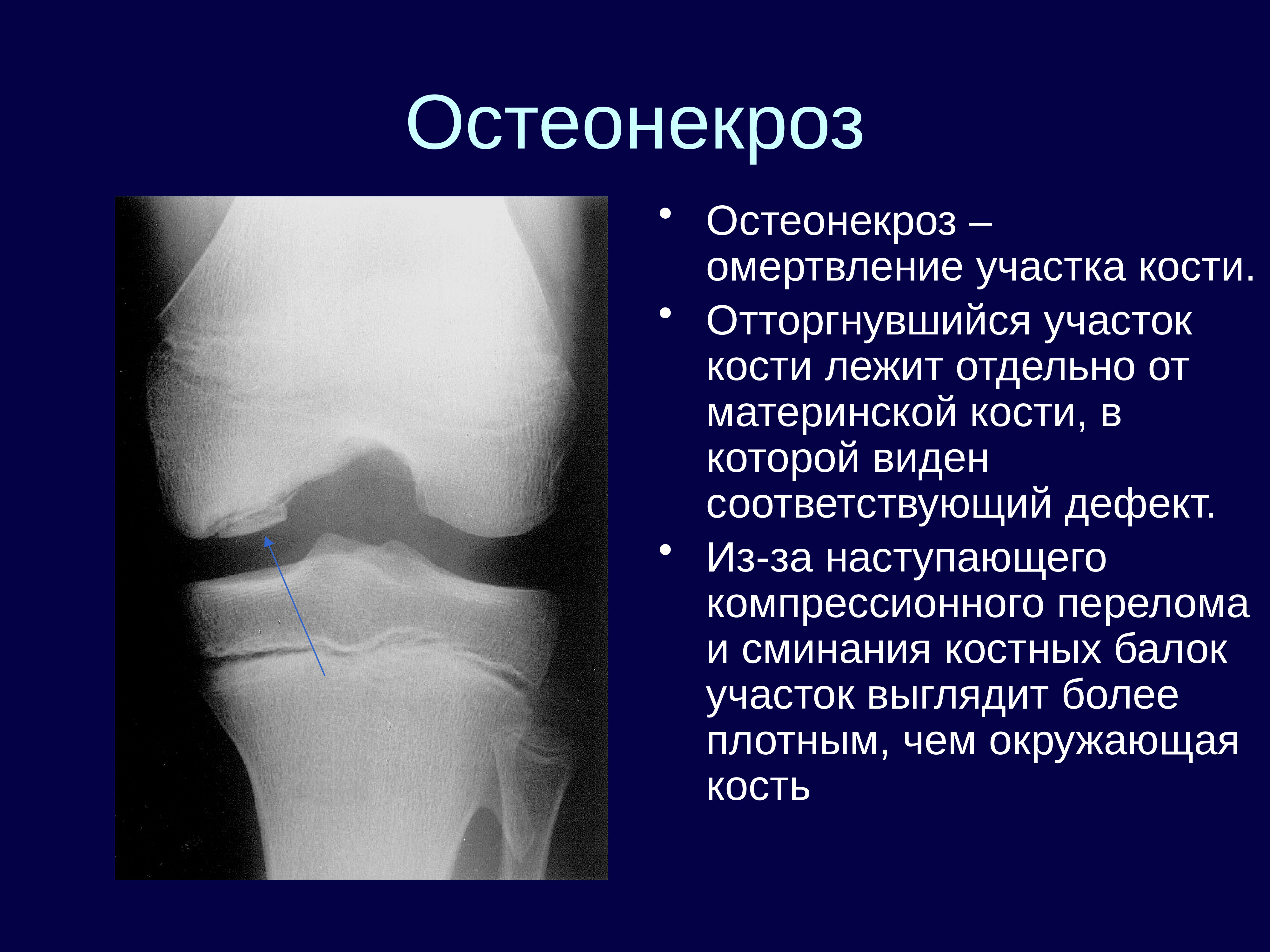 Асептический некроз мыщелков. Остеонекроз коленного сустава рентген. Асептический некроз коленного сустава рентген стадии. Субхондральный остеонекроз. Остеонекроз бедренной кости.