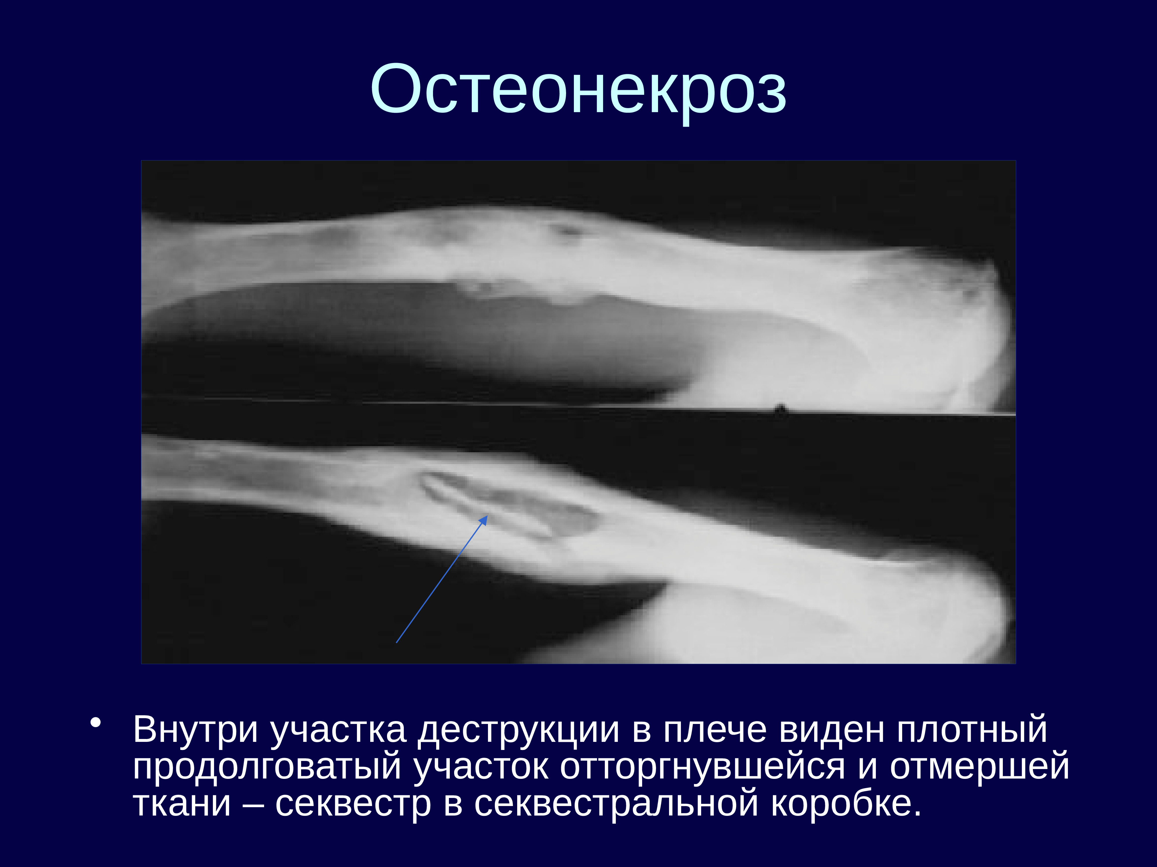 Кт картина краевой деструкции смежных костей наиболее характерна для