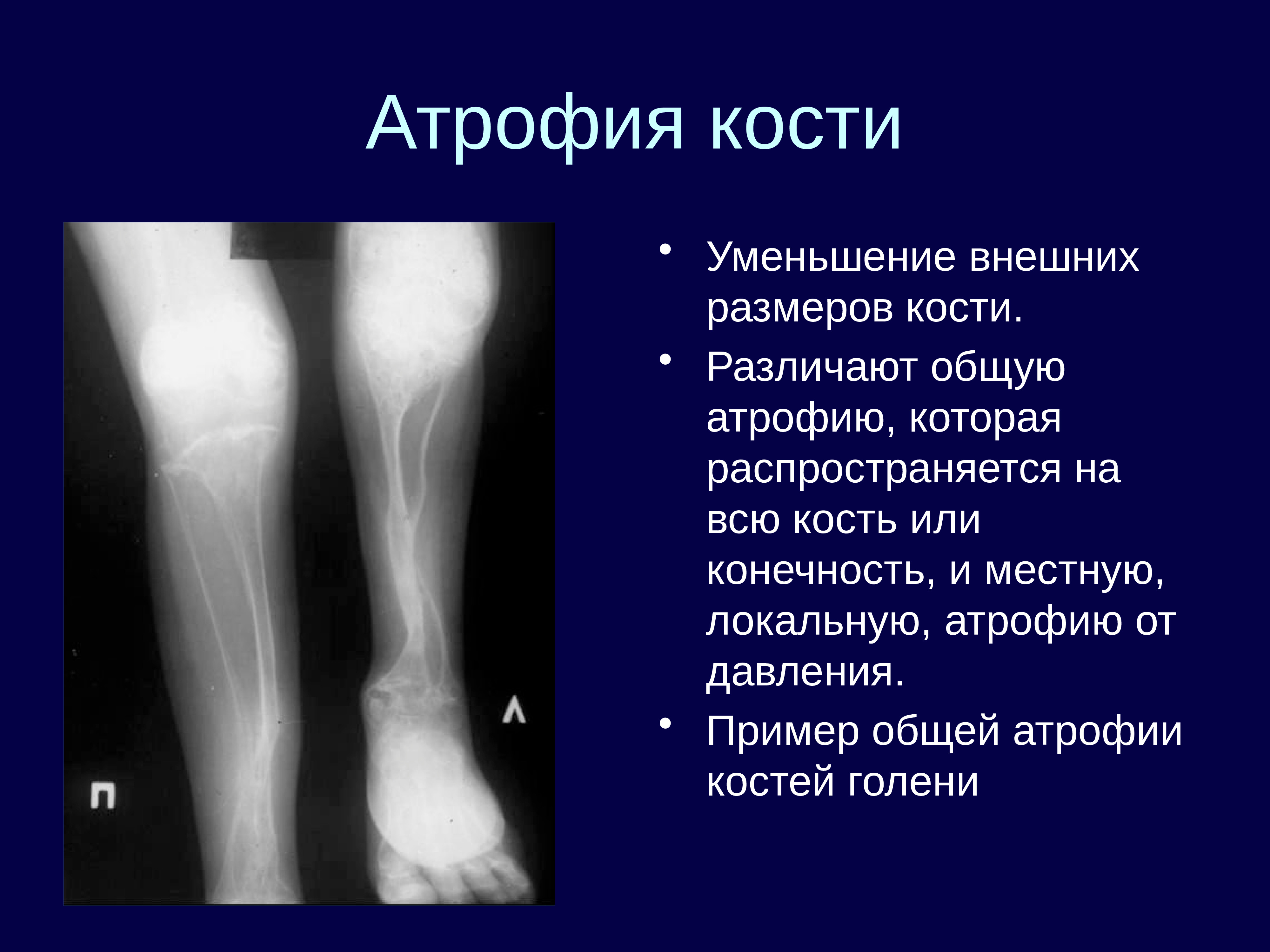 Структурные изменения костей. Атрофия рентгенологические признаки. Атрофия кости на рентгенограмме. Атрофия костной ткани на снимке.