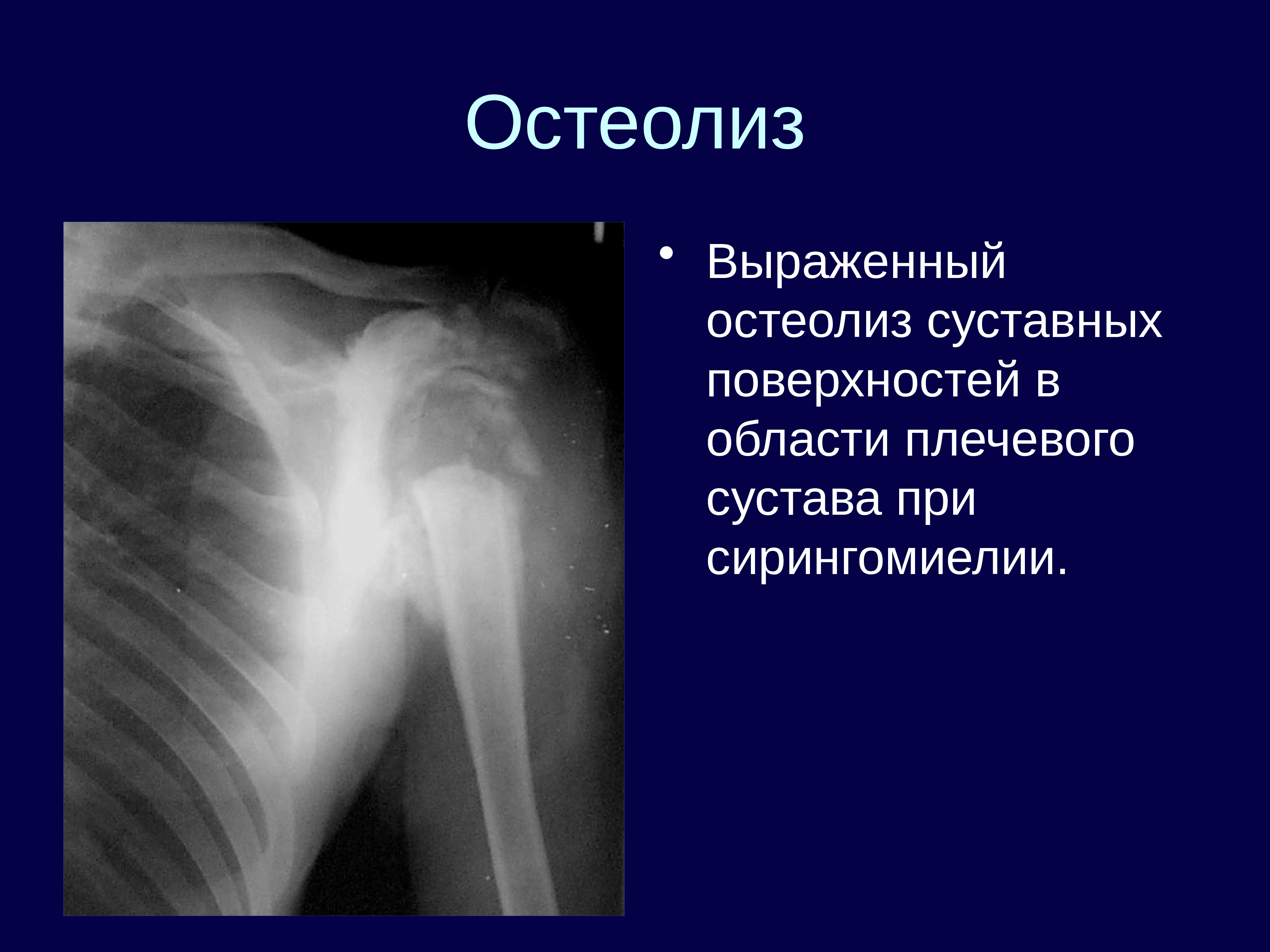 Остеолиз это. Остеолиз плечевого сустава. Остеолиз на рентгенограмме.