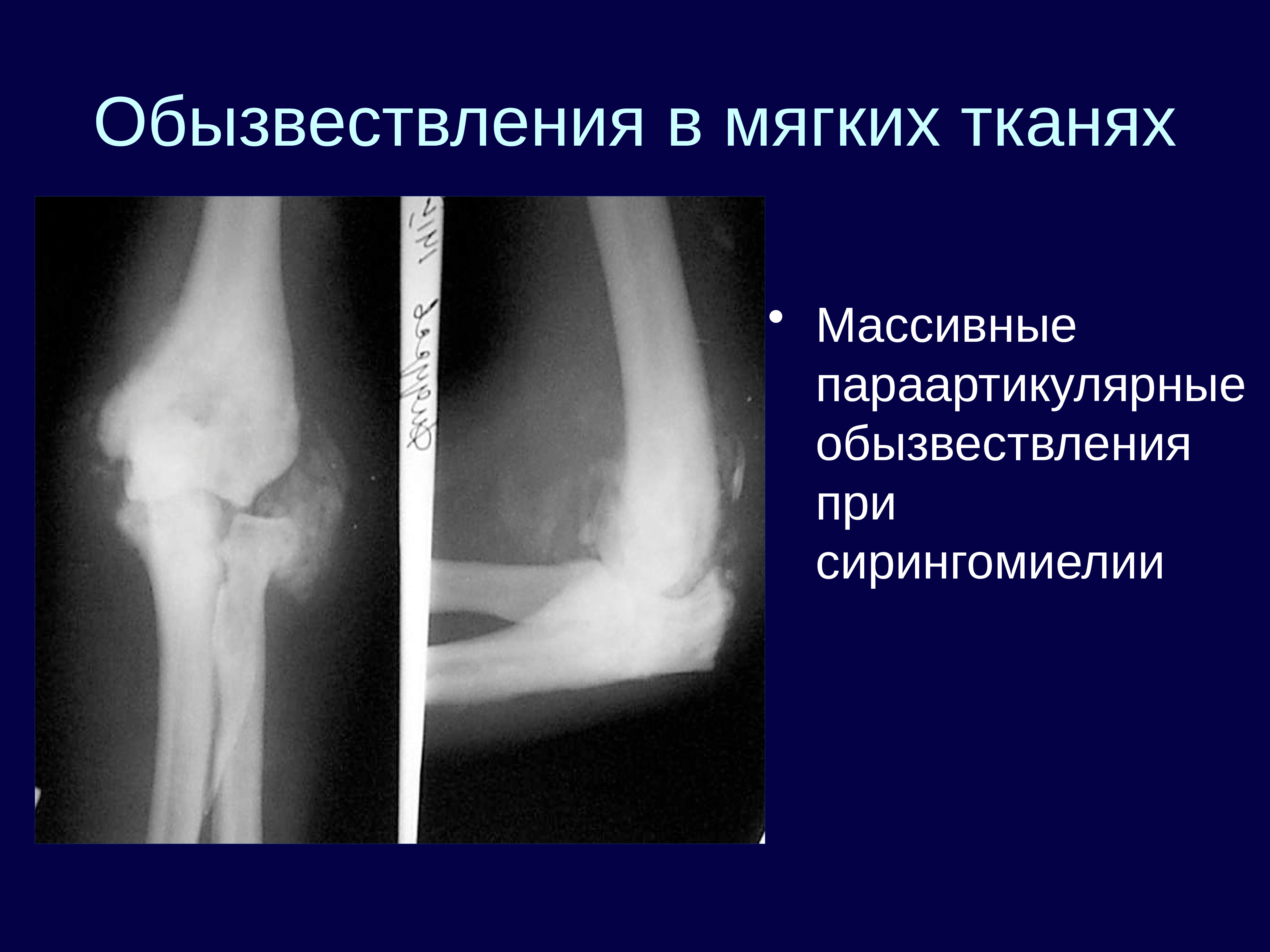 Мягкие ткани сустава. Обызвествление связок локтевого сустава рентген. Параартикулярные мягкие ткани тазобедренного сустава. Обызвествление мягких тканей тазобедренного сустава. Обызвествление в мягких тканях коленного сустава рентген.