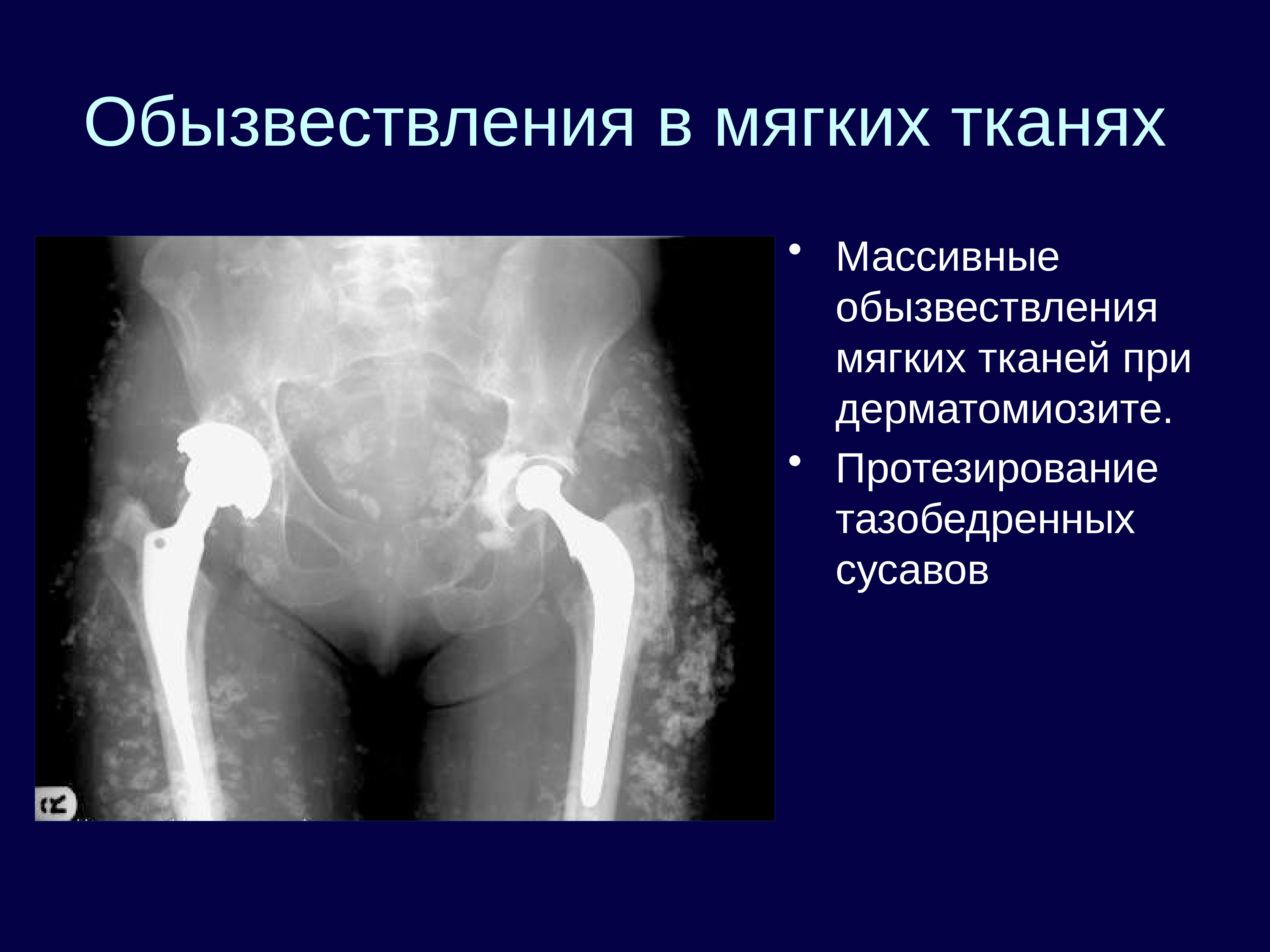 Обызвествление мышцы бедра