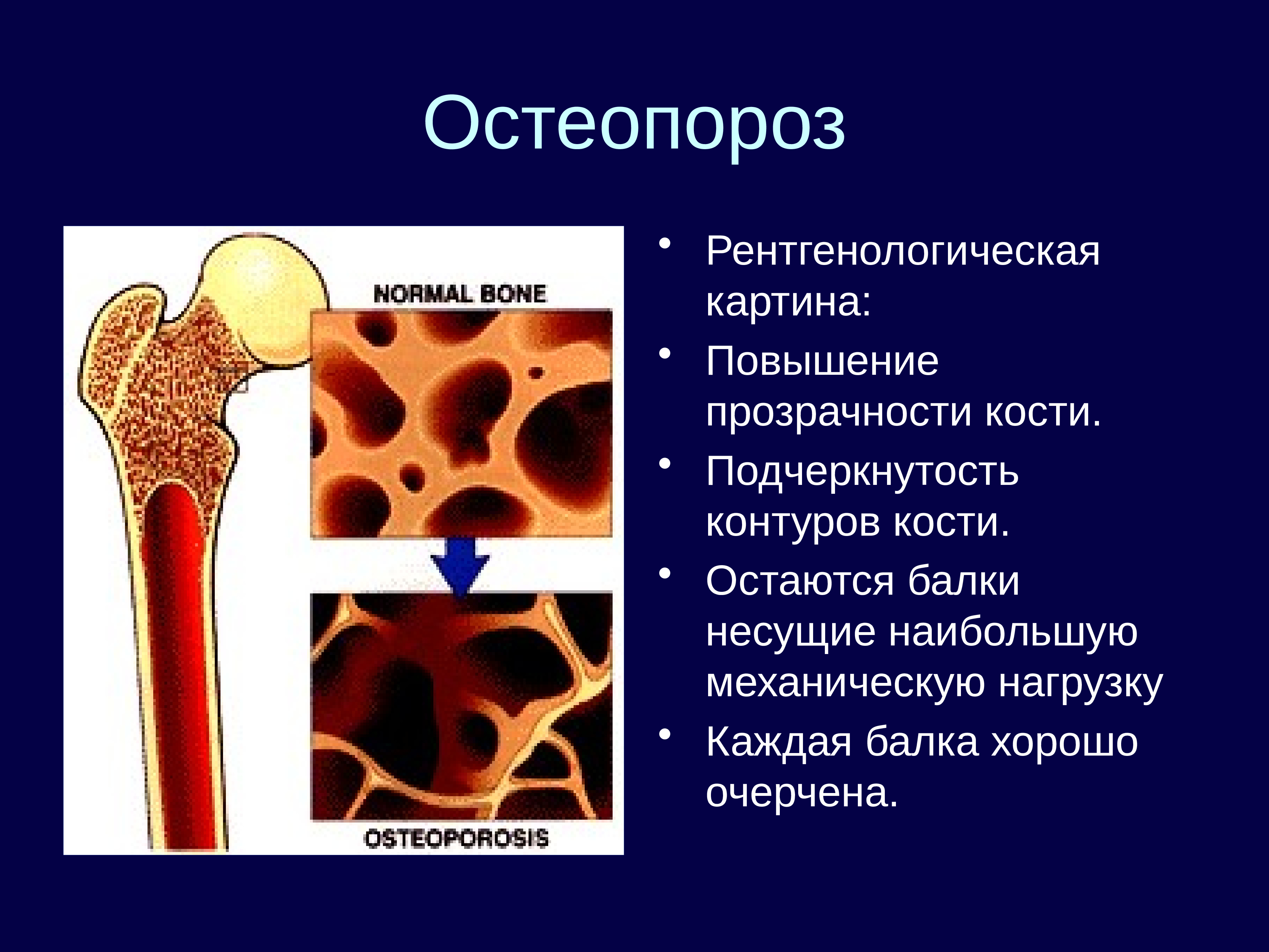Улучшает кости. Остеопороз. Рентгенологическая картина остеопороза. Изменение костной структуры.