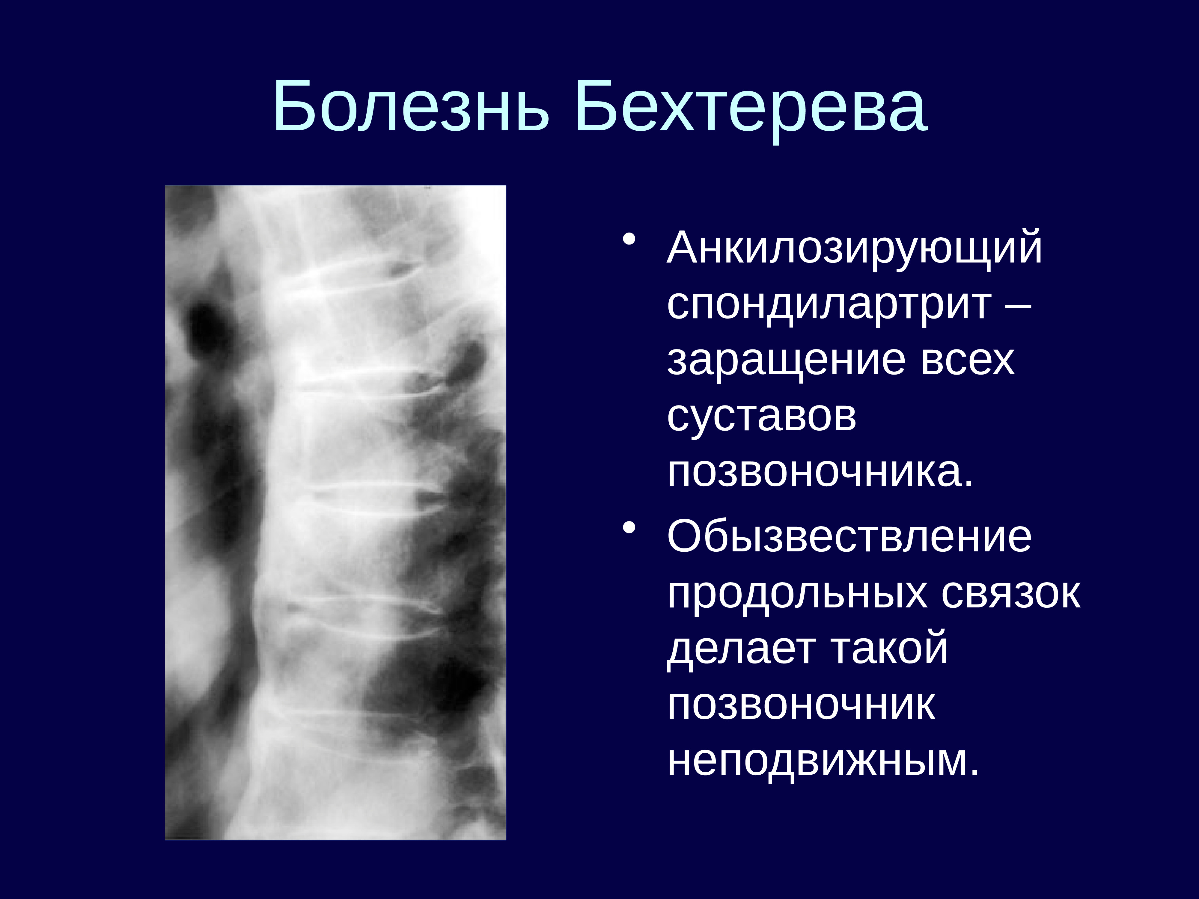 Болезнь бехтерева кт картина