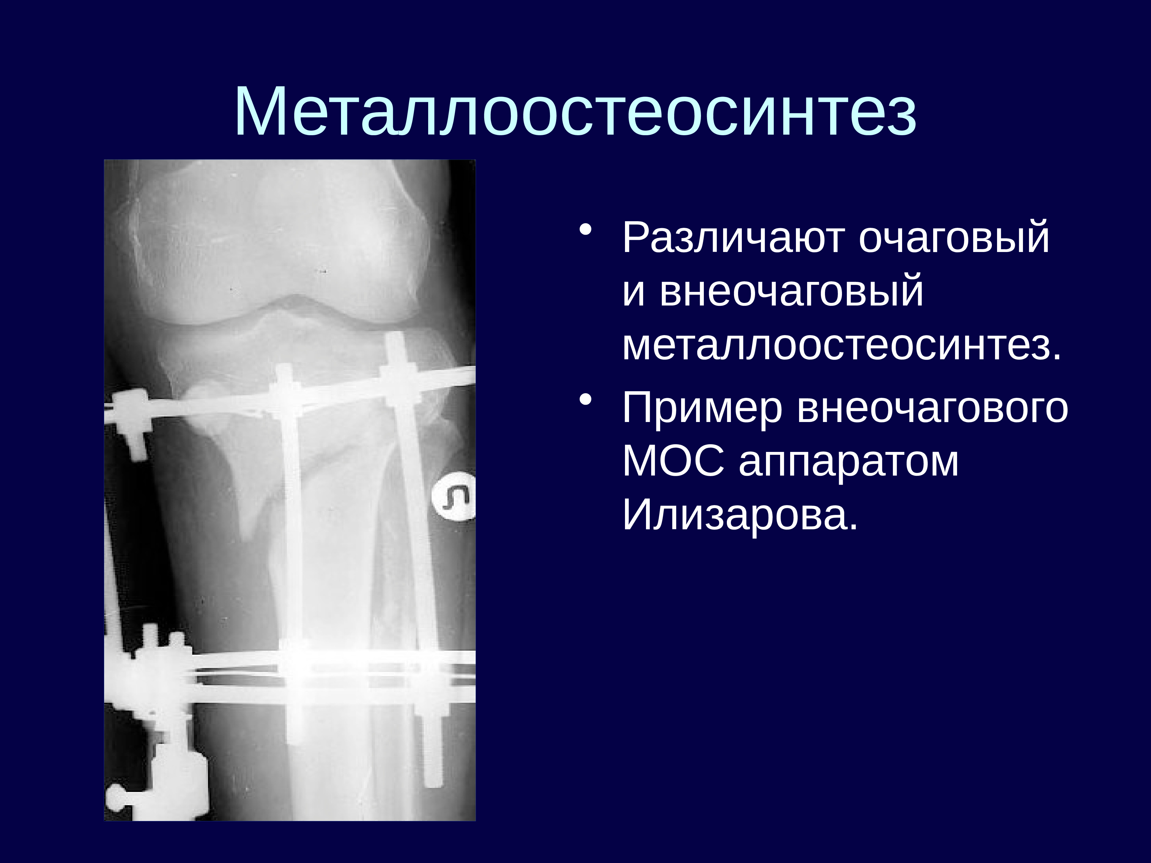 Внеочаговый остеосинтез презентация