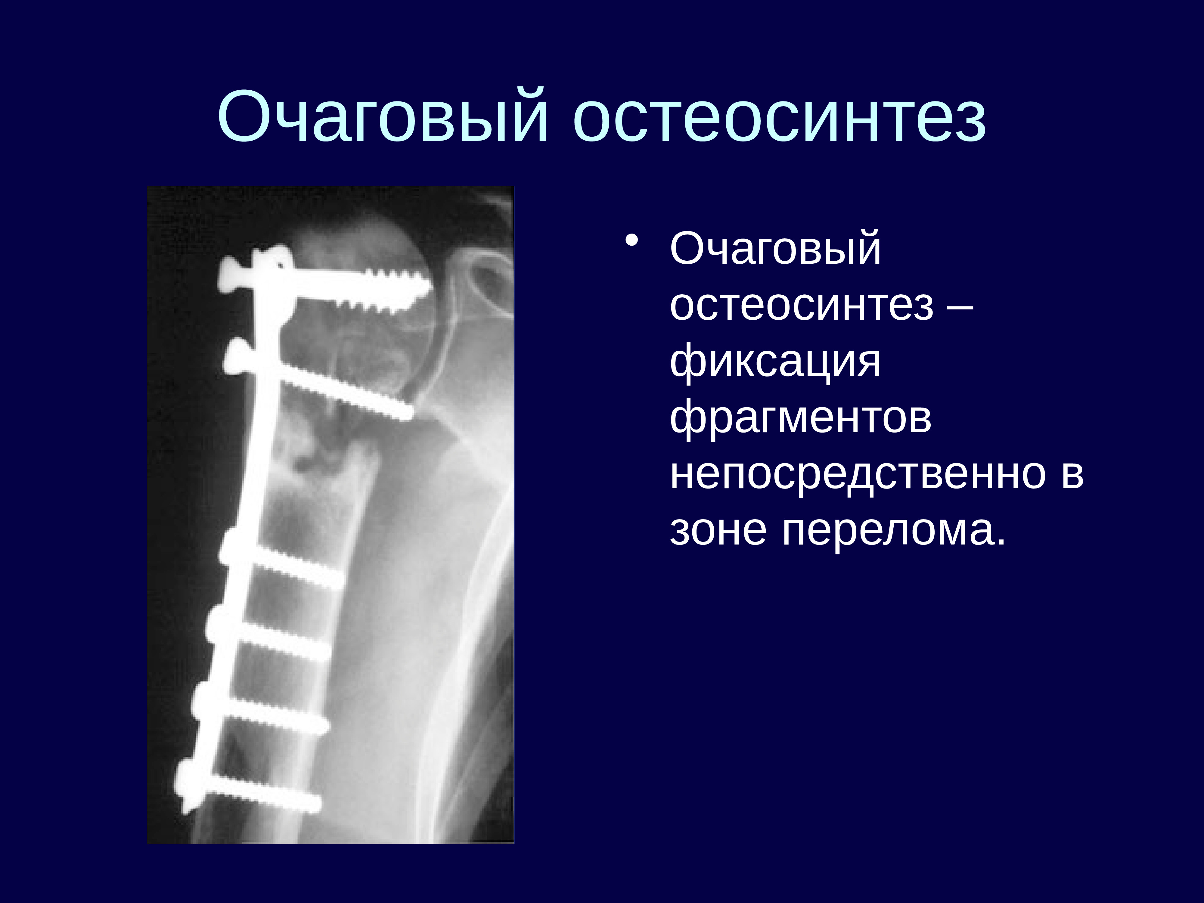 Внеочаговый остеосинтез презентация