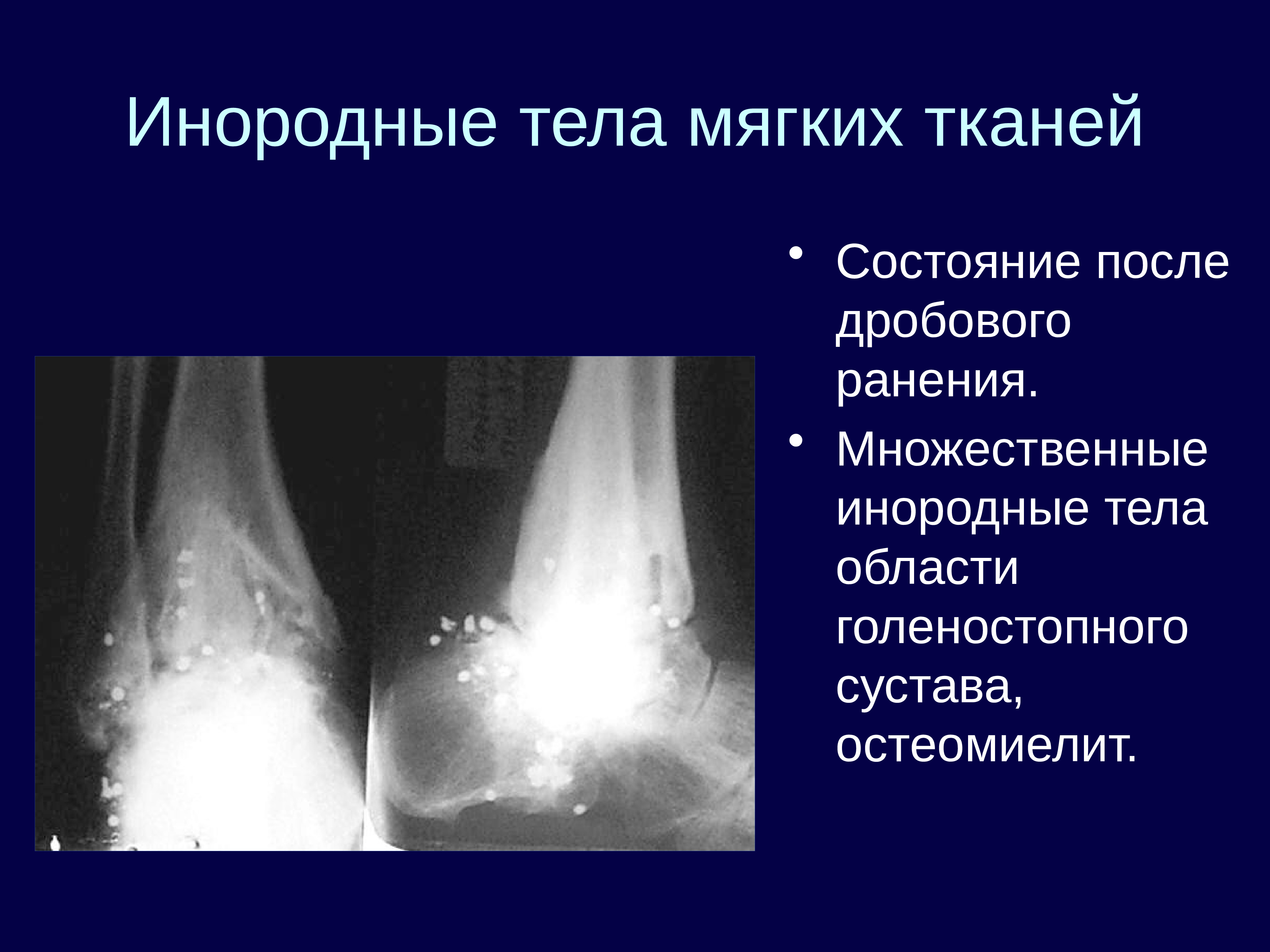 Состояние тканей. Инородное тело мягких тканей. Инородные тела мягких тканей презентация. Инородное тело мягких тканей УЗИ. Остеомиелит голеностопного сустава.