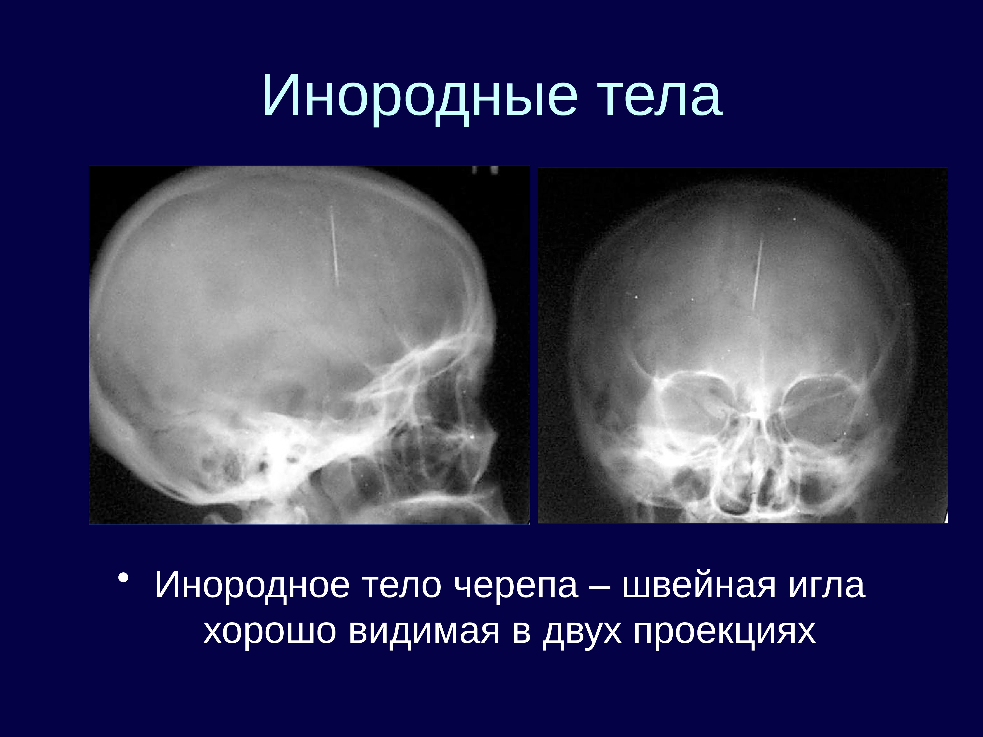 лучевая диагностика череп. методы лучевого исследования черепа:. методы исследования черепа. остеопетроз позвоночник кт. множественная миелома рентген черепа.