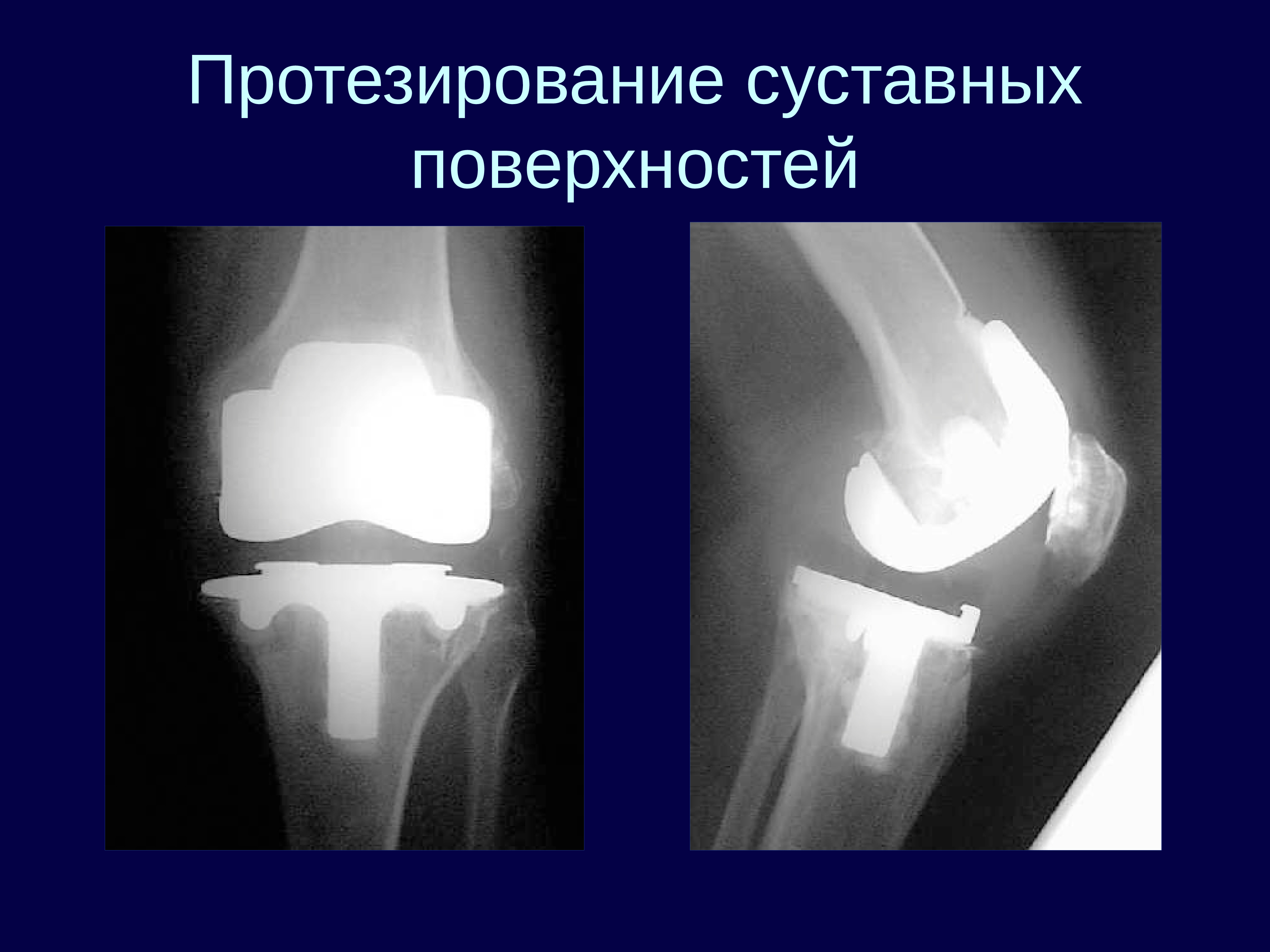 Краевые костные заострения суставных поверхностей. Смещаемость суставных поверхностей. Заострения суставных поверхностей суставов. Патологическая смещаемость суставных поверхностей.