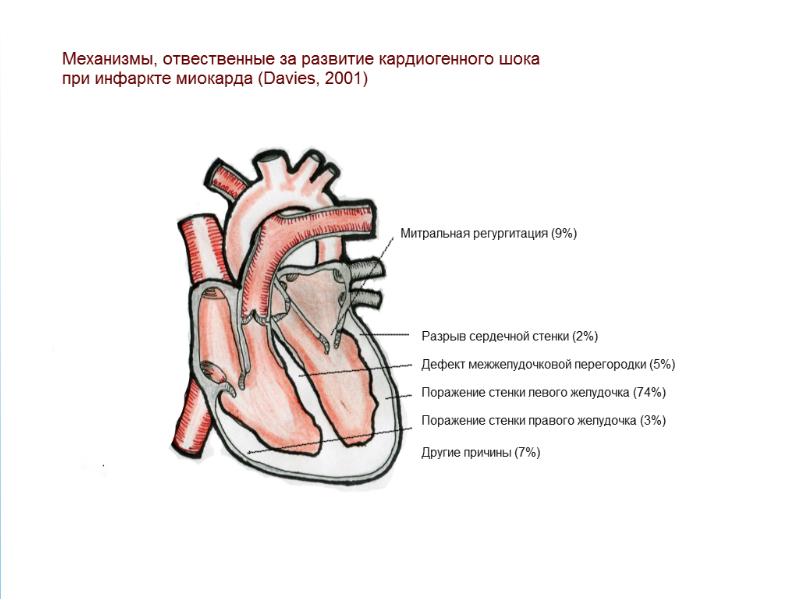 Клиническая картина кардиогенного шока