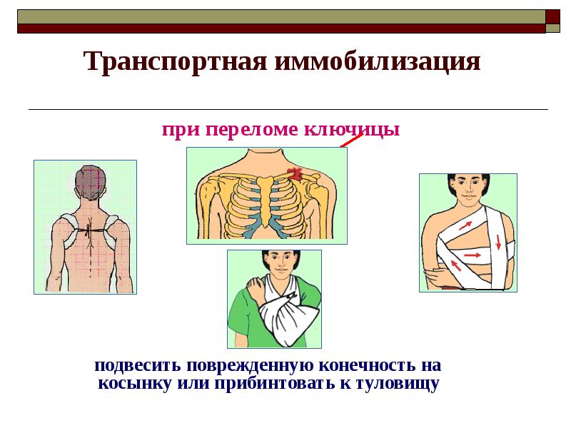 Транспортная иммобилизация при переломе ключицы. Транспортная иммобилизация при переломе ключицы осуществляется:. Перелом ключицы транспортная иммобилизация. Иммобилизация при переломе ключицы. Транспортная иммобилизация при переломе ключицы Дезо.