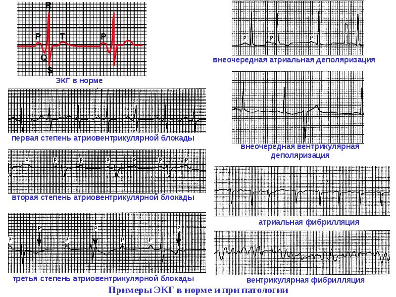 При каких патологиях. ЭКГ патологии норма ЭКГ. Показатели ЭКГ при патологии. Патологии сердца на ЭКГ. Патологии ЭКГ на кардиограмме.